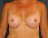 Feel Beautiful - Breast Augmentation 140 - After Photo